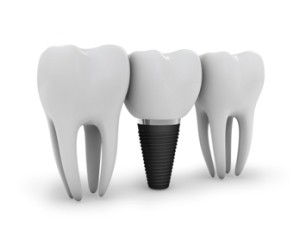 Swiss Dental Implant Center - Swiss Technique natural dental implants - Portland Oregon OR