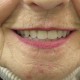 Dental Implants - Dentures - Portland Oregon OR